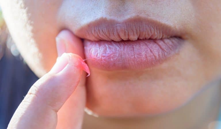 Dry Skin and Chapped Lips During Pregnancy: Causes and Remedies